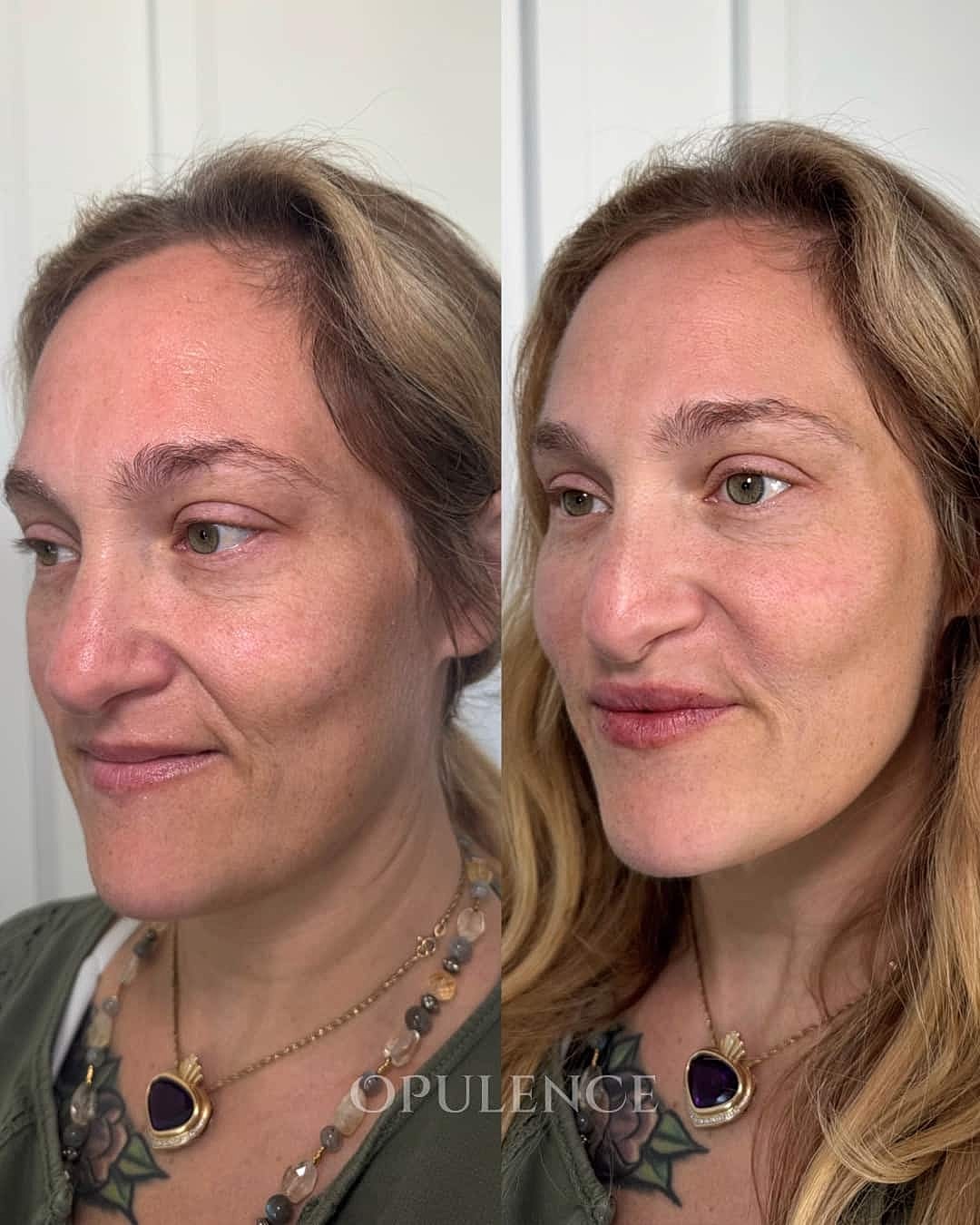 Botox, Fillers & Injectables Before & After